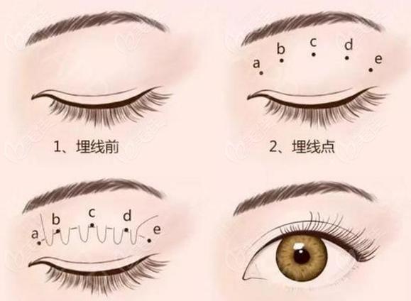 河北邯郸第三医院整形美容 埋线双眼皮价格表_河北邯郸第三医院整形美容 埋线双眼皮医生推荐_做双眼皮要价格暴跌